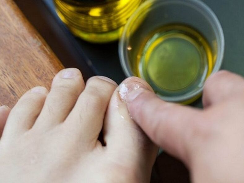 Aceite da árbore do té para fungos nas unhas dos pés