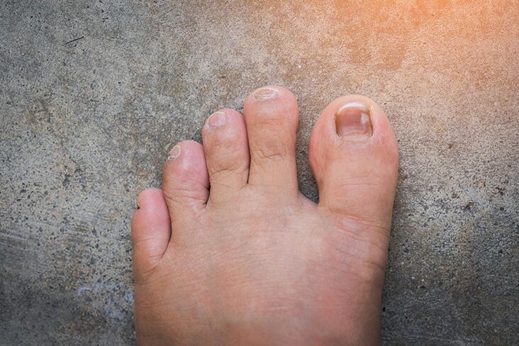 Fungo das uñas