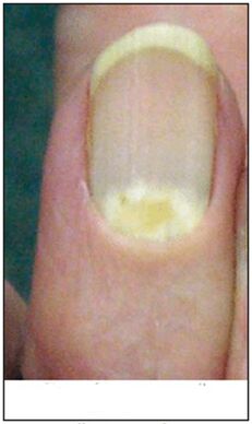 Fungo de deformación proximal