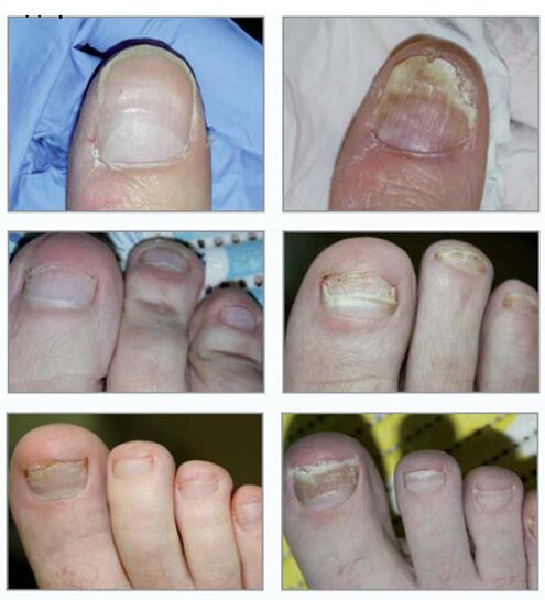 Tipos de fungo das uñas