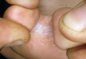 Terapia das persoas