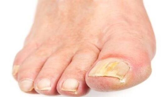 amarelado das uñas debido á infección por fungos