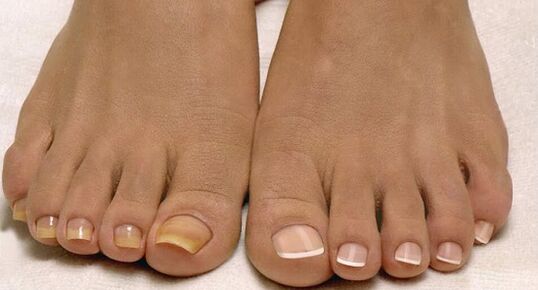 uñas normais e fungo das uñas