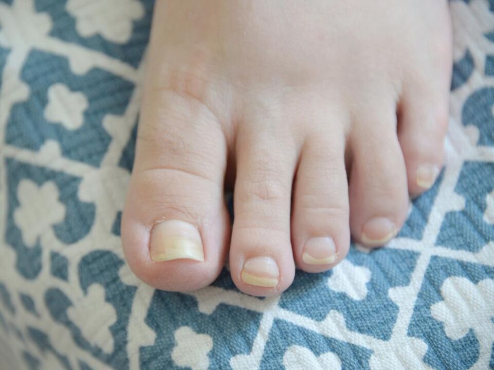 fungo nas unhas dos pés