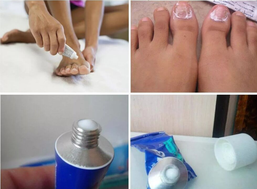 medicamento para unha fungo do pé