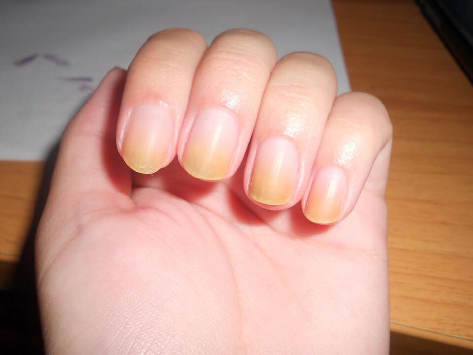 síntomas de fungo das unhas
